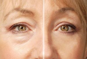 blefaroplastia